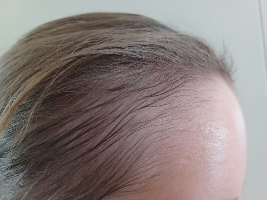 Right temporal photo, 3 months into treatment 