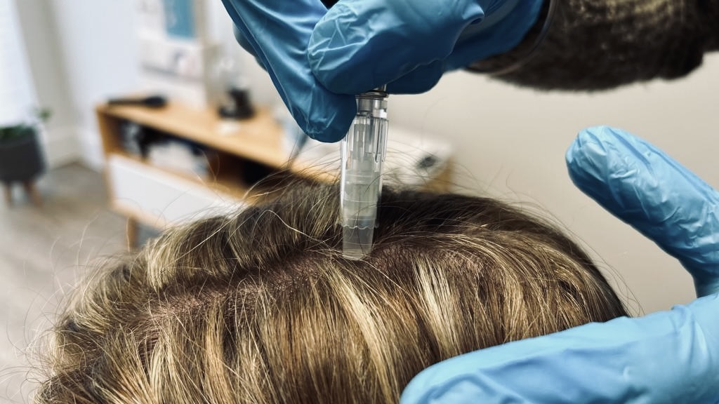 Collagen induction therapy (microneedling)