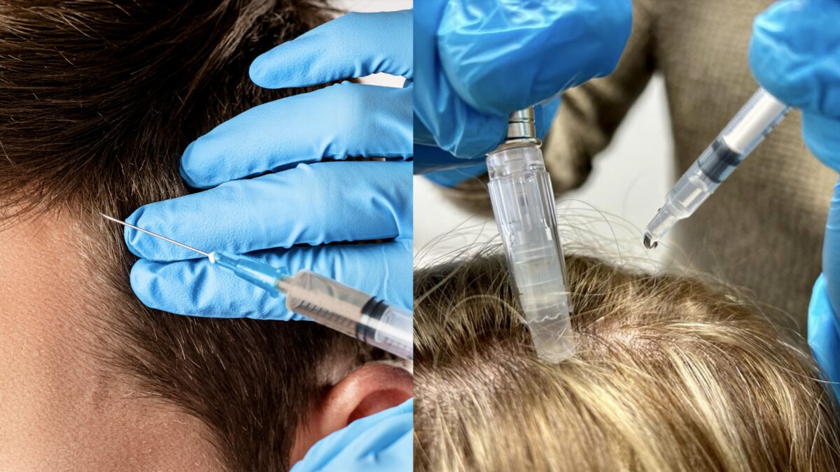 Collagen induction therapy (microneedling)