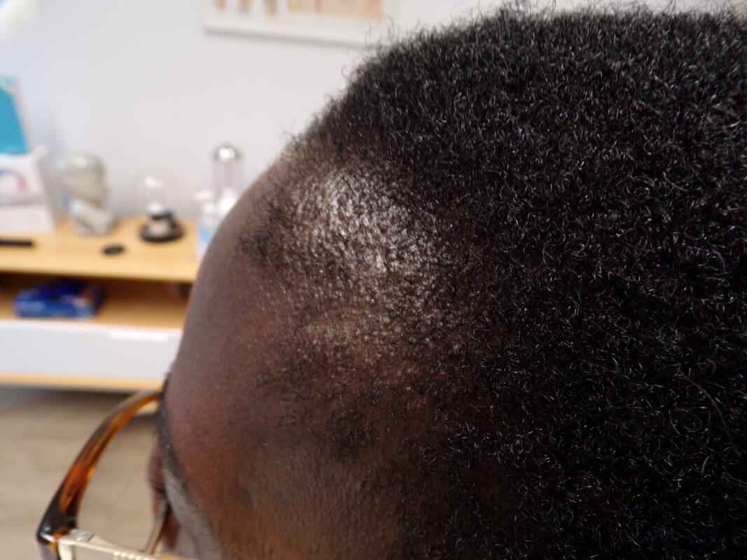 Left frontal temporal photo before treatment
