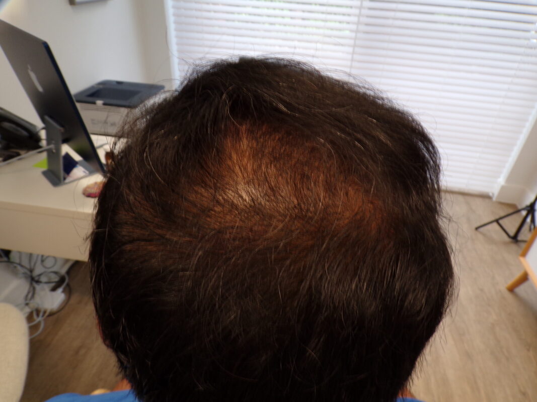 Crown after 8 months 