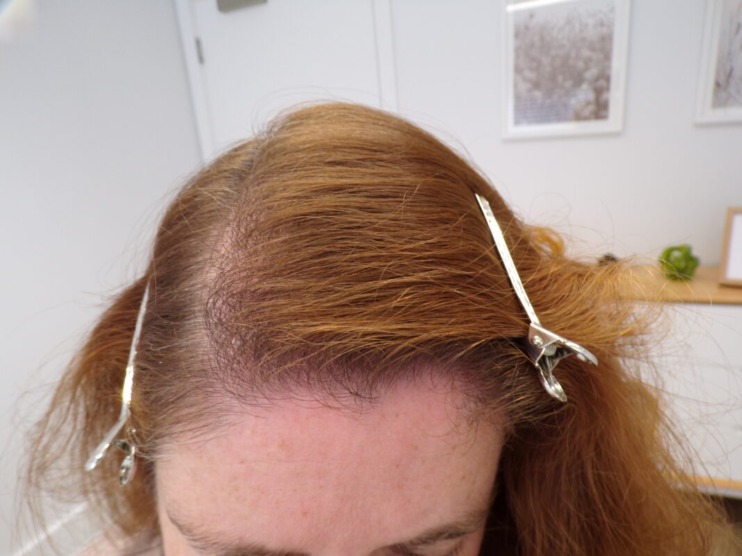 Hair  after 3 months of treatment