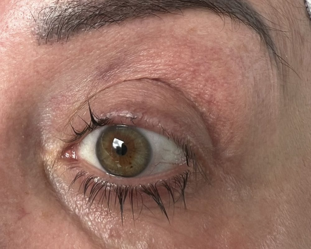 Left eye before treatment