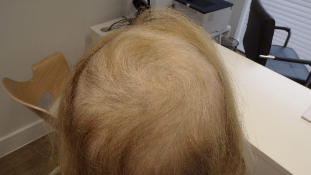 Understanding White Hair Growth in Alopecia Areata
