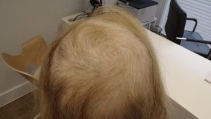 Understanding White Hair Growth in Alopecia Areata
