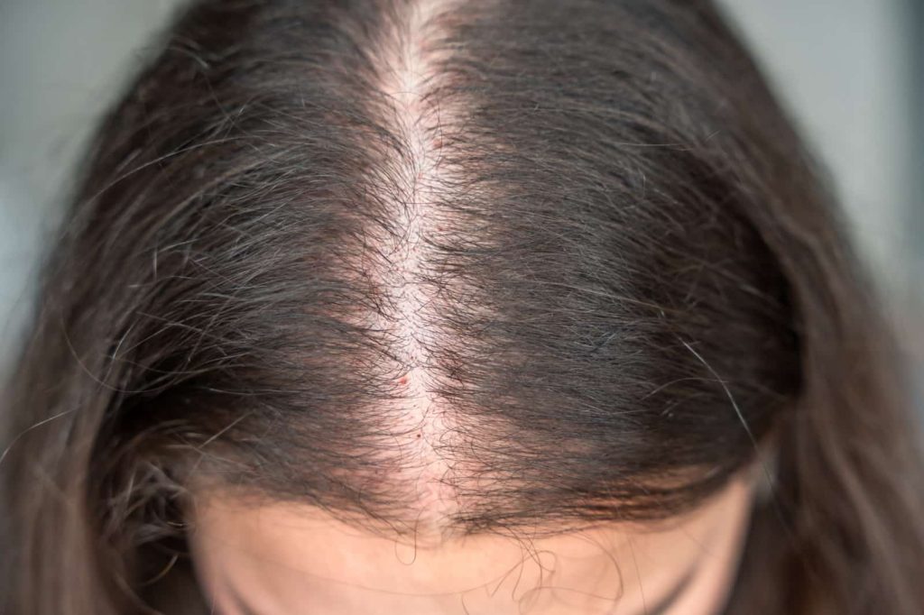 Expert hair thinning solutions in the UK