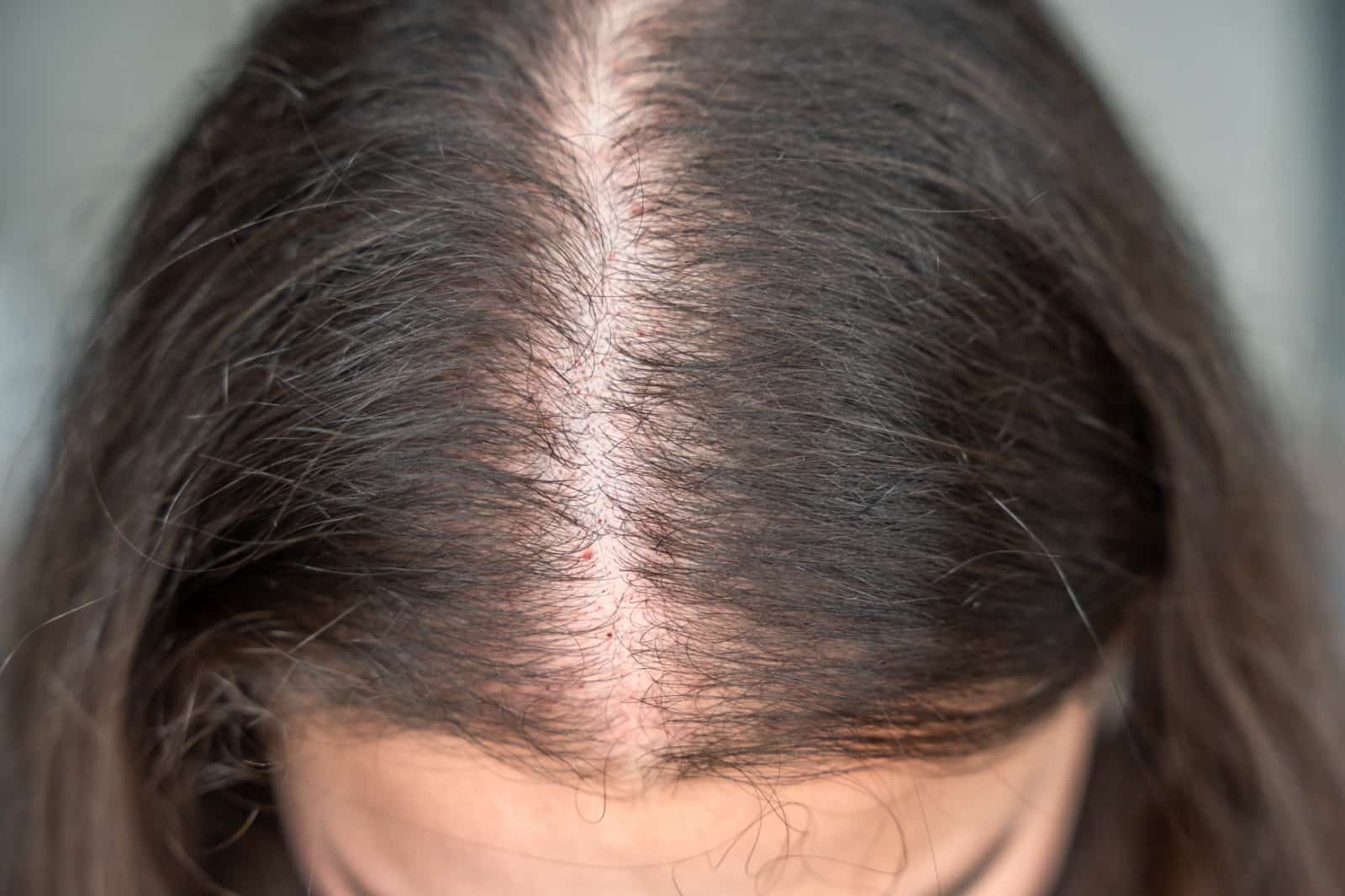 Expert hair thinning solutions in the UK