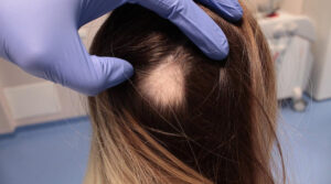 Gloved hands parting a woman’s hair to reveal a smooth, round bald patch caused by alopecia areata
